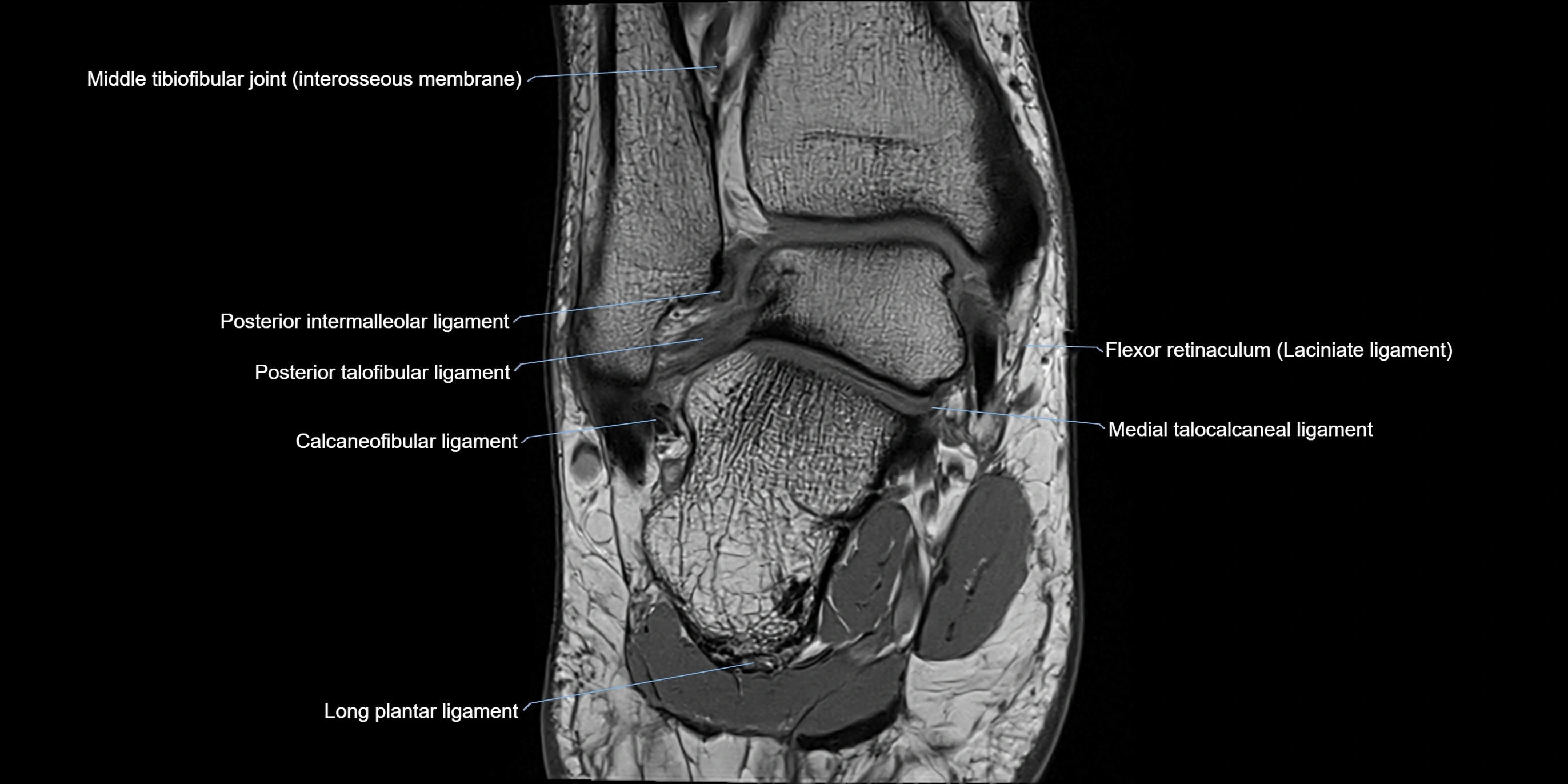 MRI Ankle coronal ligaments cross sectional anatomy 3T  radiology  image-img-00001-00016.webp